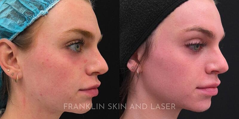 UltraClear Before & After Image