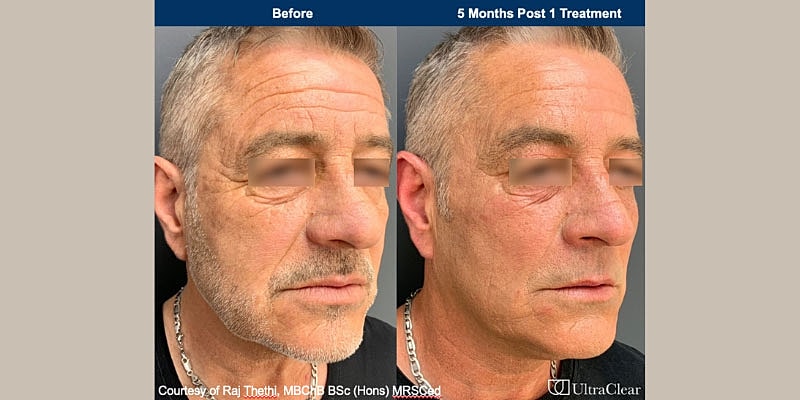 UltraClear Before & After Image
