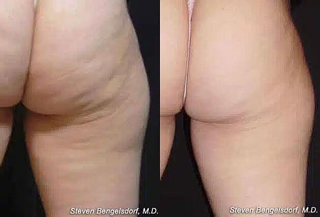 Cellulite Reduction Before & After Image
