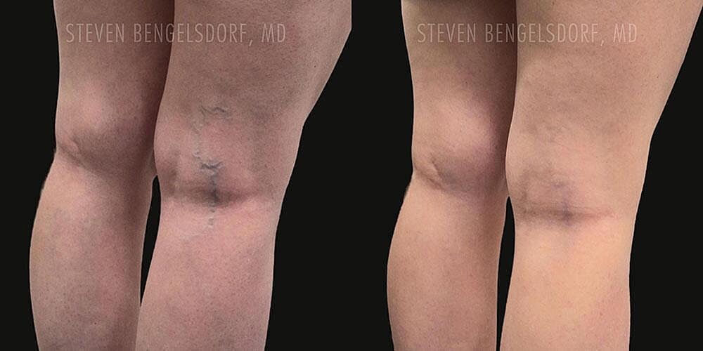 Sclerotherapy Before & After Image