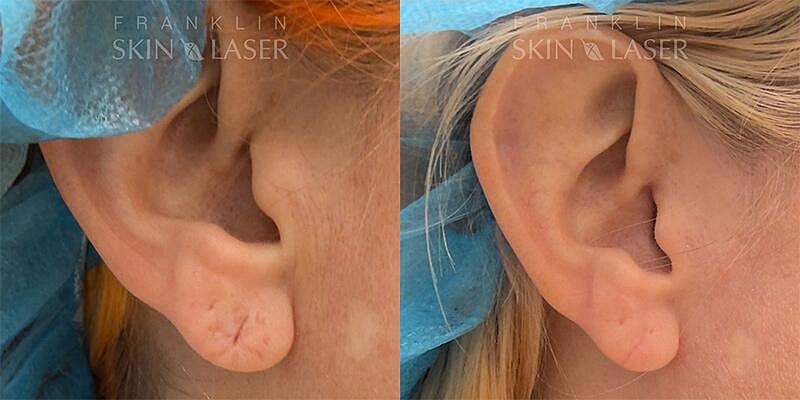Earlobe Repair Before & After Image