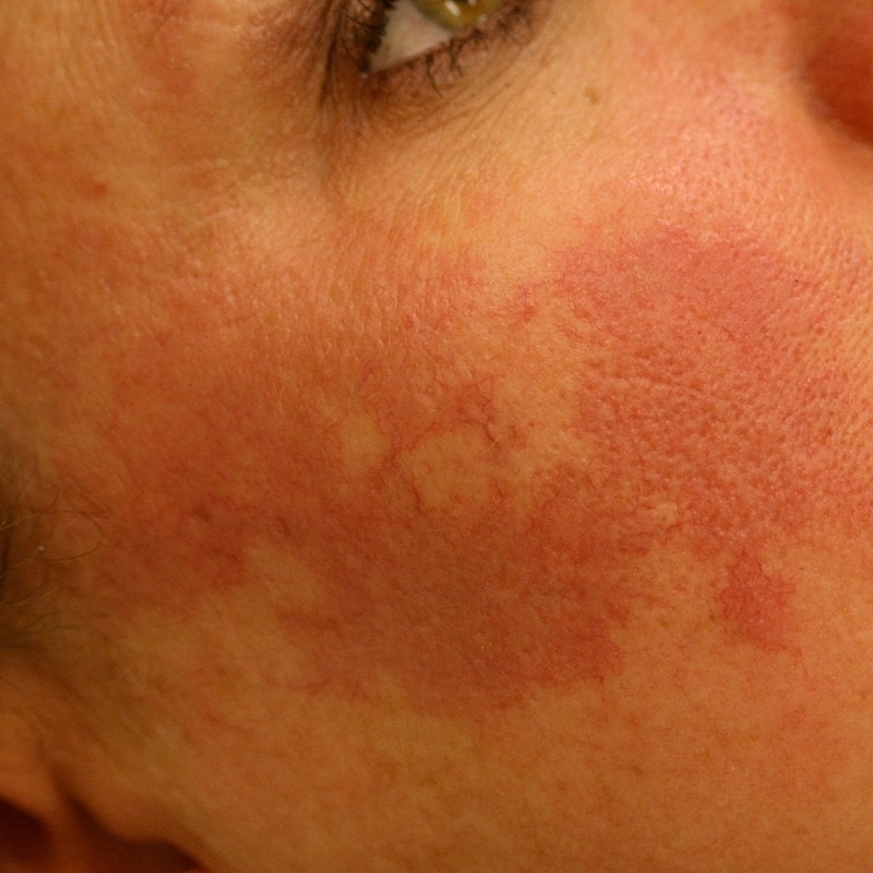 Photo Port Wine stain before