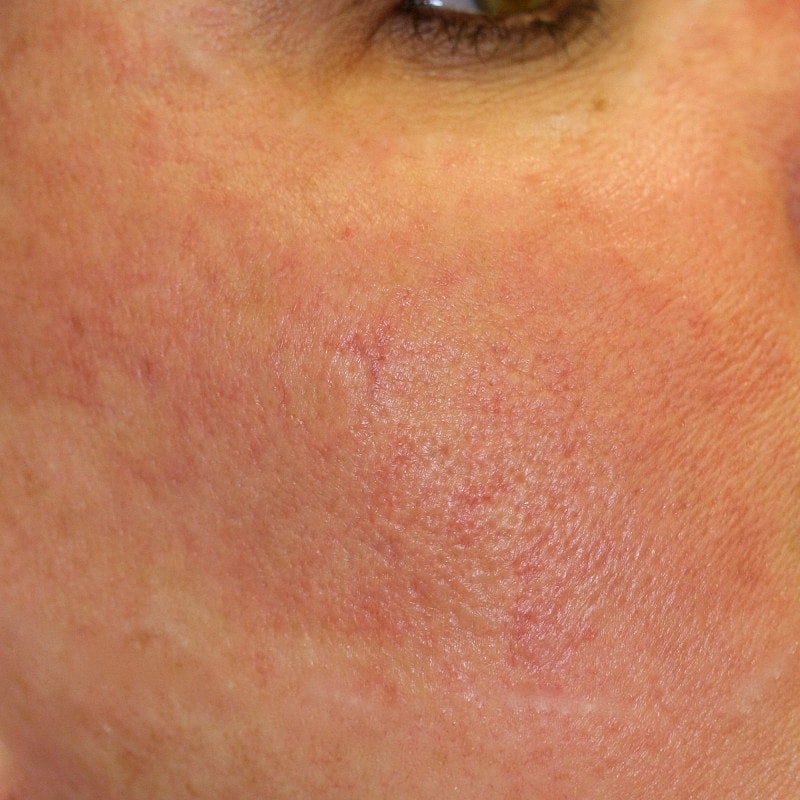 Photo Port Wine stain after