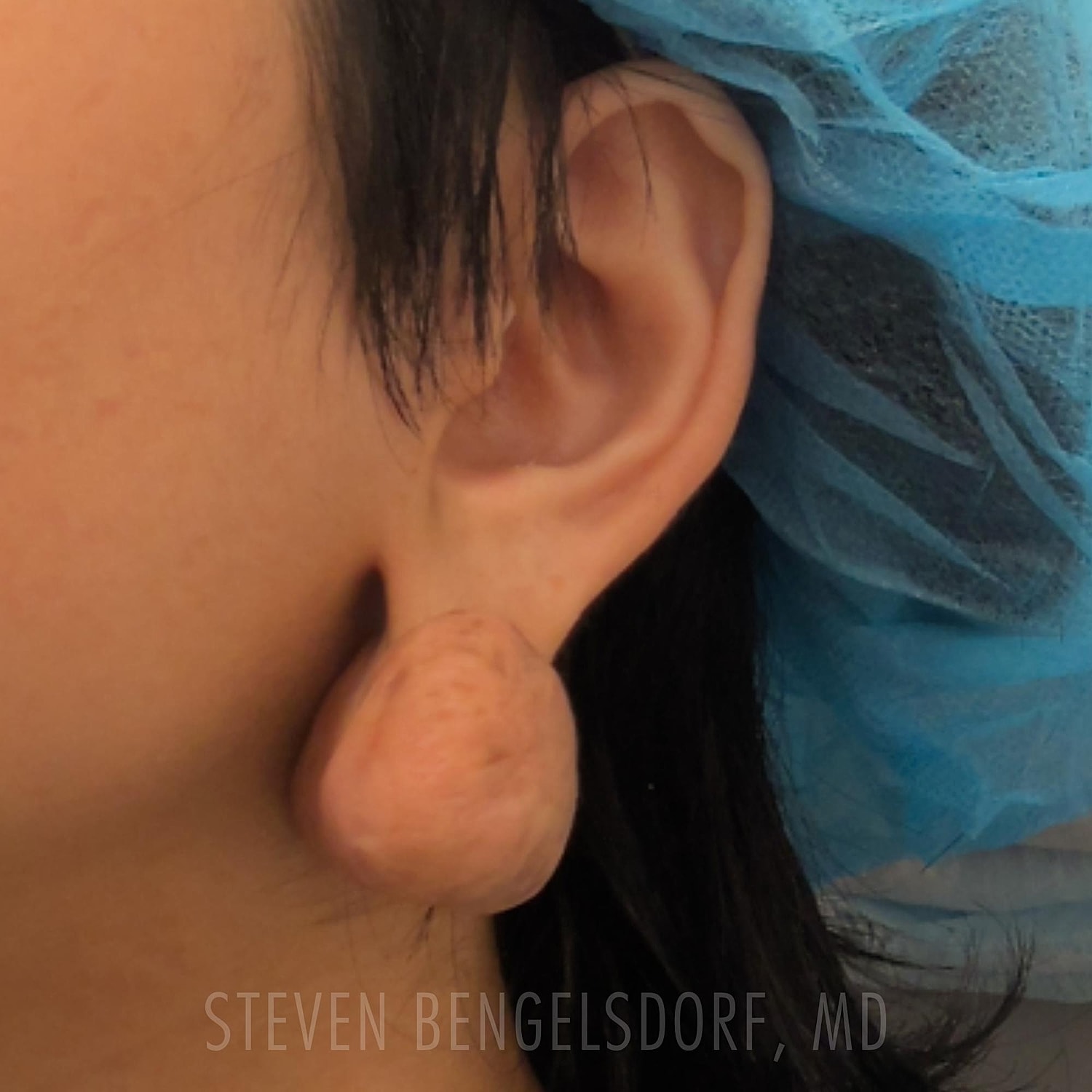 Keloid removal before