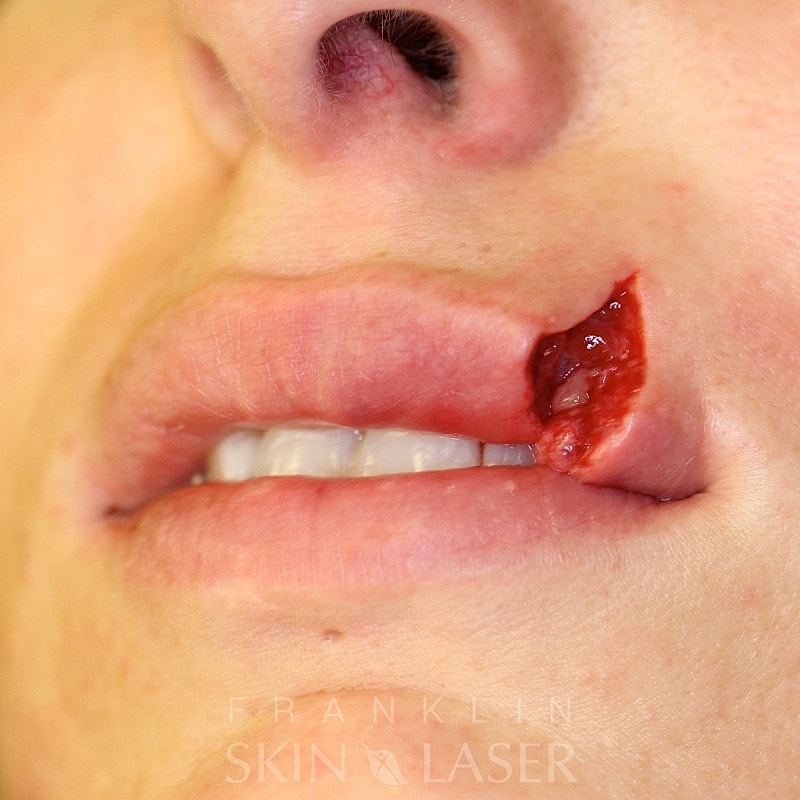 Scar removal before
