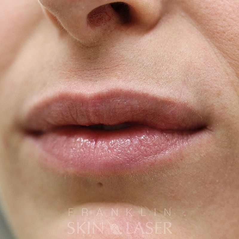 Scar removal after