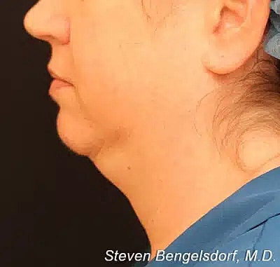Kybella before image