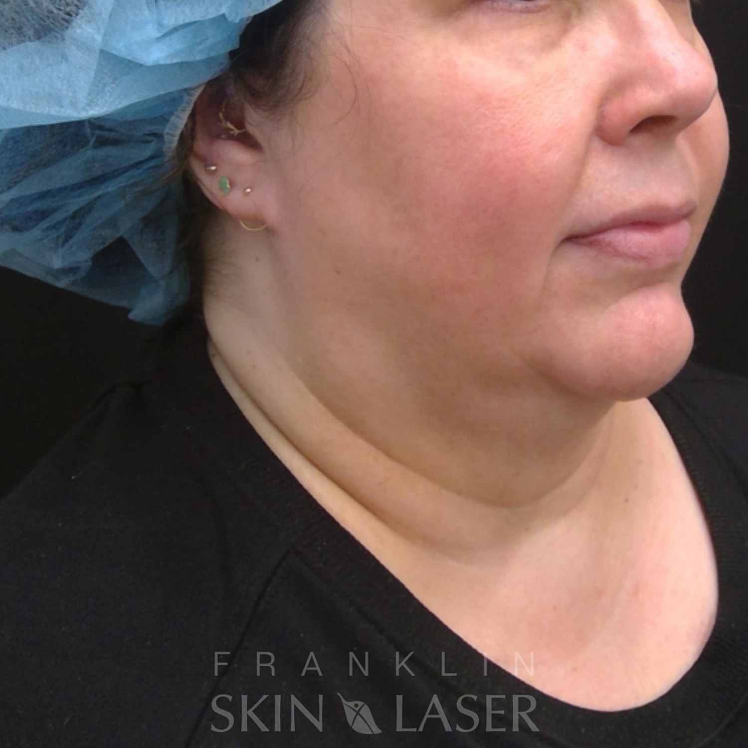 Kybella after image