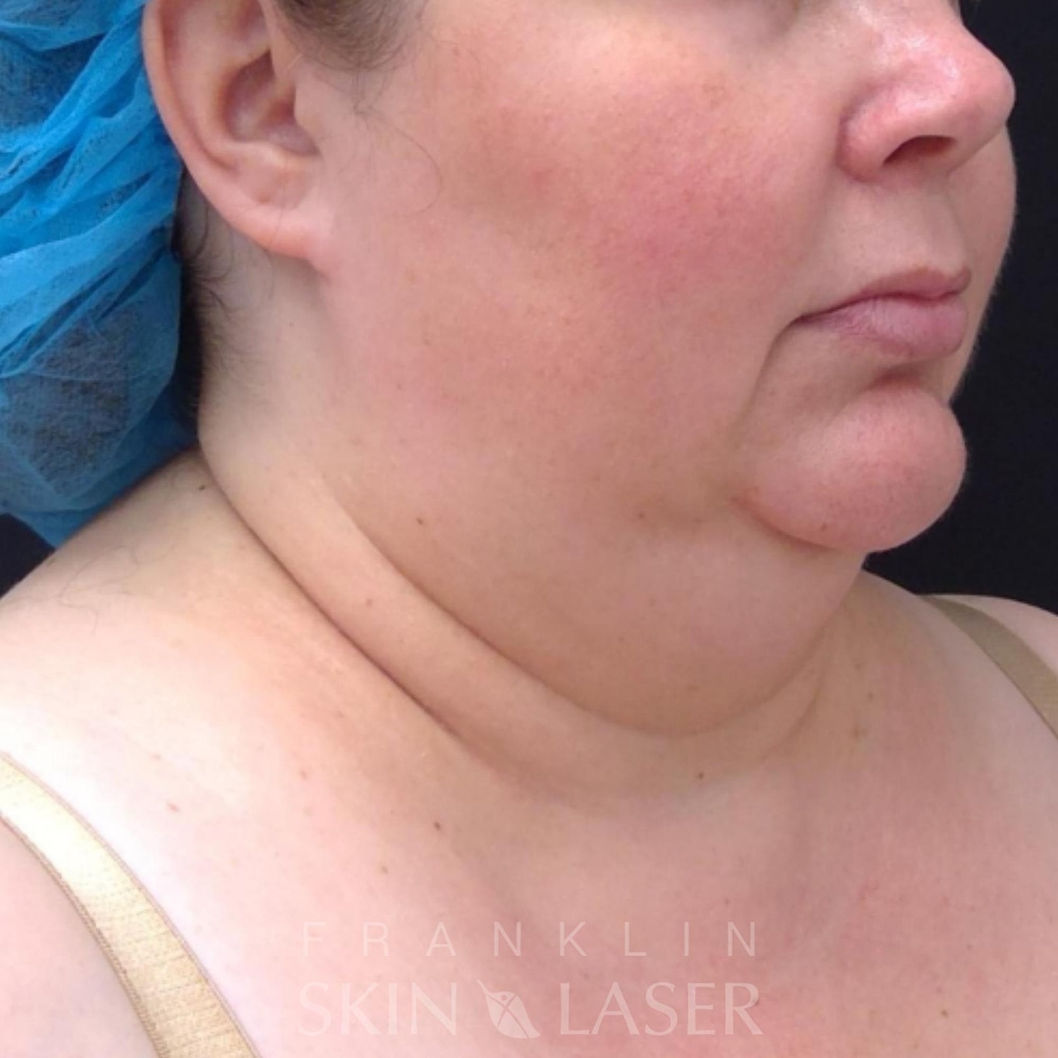 Kybella before image