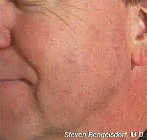 Mole removal after image