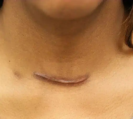 Scar1 before image