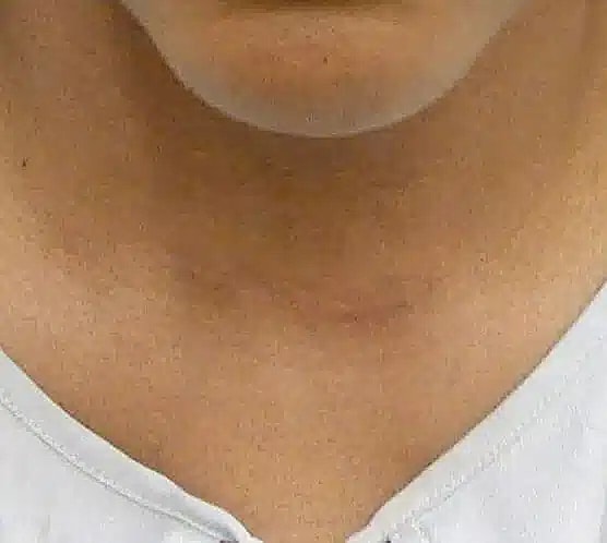 Scar2 after image